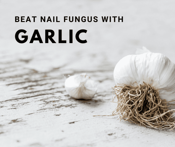 10 Natural Remedies to Get Rid of Nail Fungus