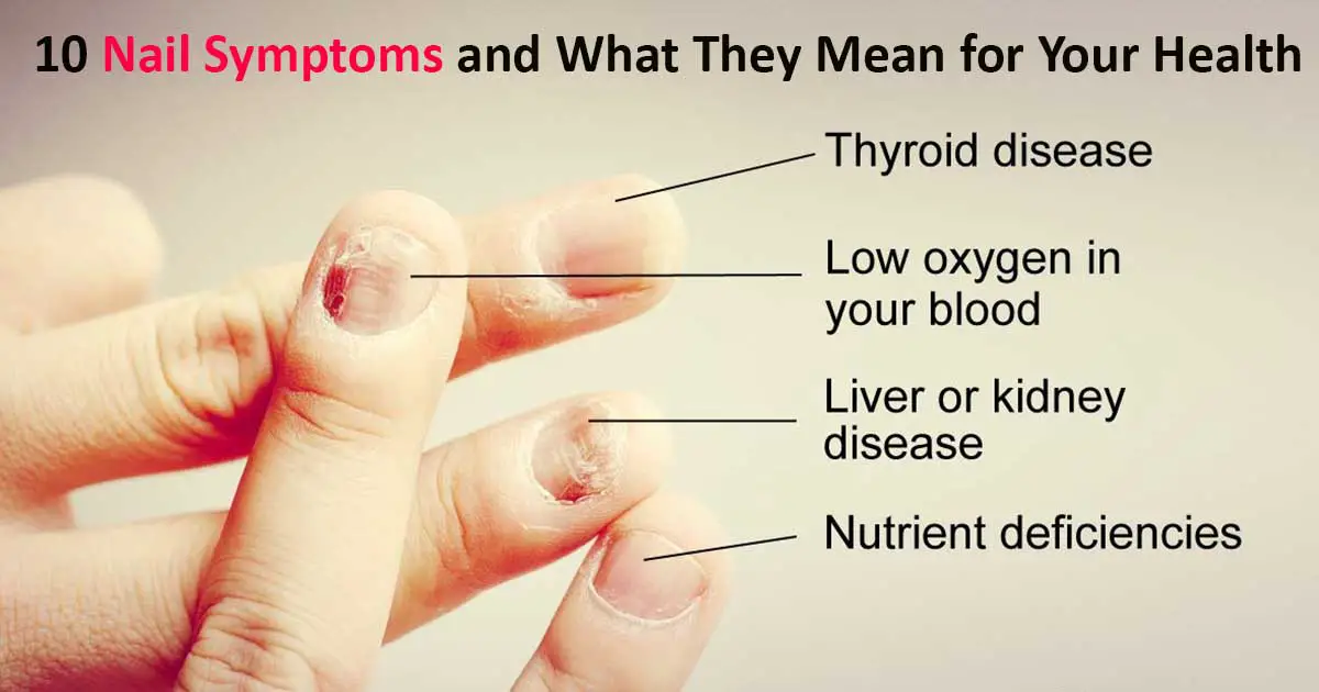 10 Pictures of What Your Nails Say about Your Health