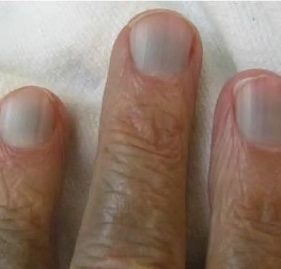 10 signs of internal disease expressing through nails