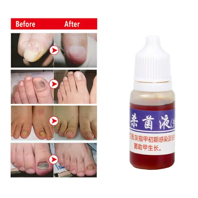 10ml Essence Oil Nail Fungus Killer Toe Fungus Treatment Onychomycosis ...