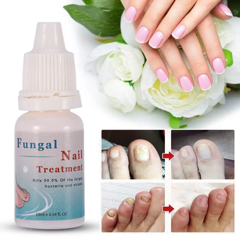 10ML Fungal Nail Treatment Essence Nail Foot Whitening Toe Nail Fungus ...
