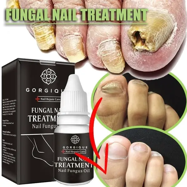 10ml Toenail Fungus Treatment Fungus Removal Treatment Anti Infection ...