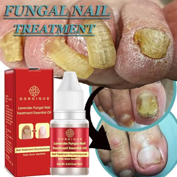 10ml/20ml/30ml/50ml Anti Fungal Nail Treatment Finger Toe Nail Repair ...