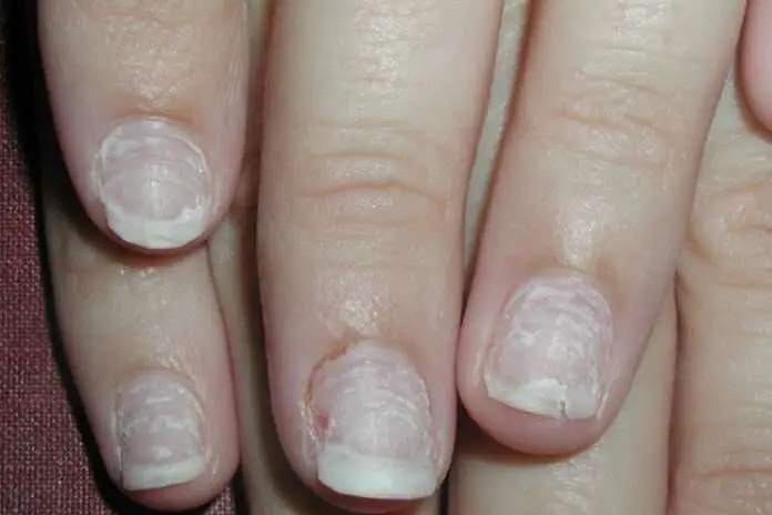 12 Beauty Hacks for Repairing Damaged Nails