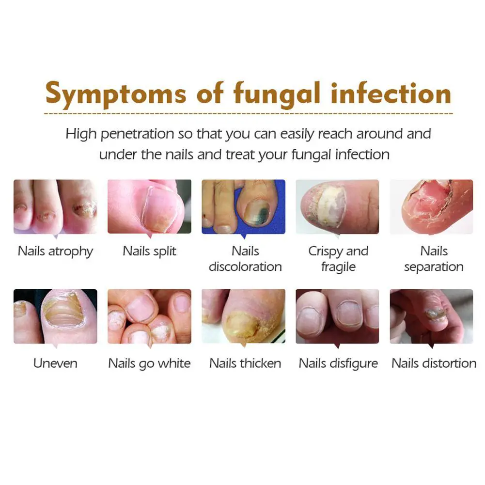 15ml Fungal Nail Treatment Essence Repair Toe Finger Anti Fungus ...