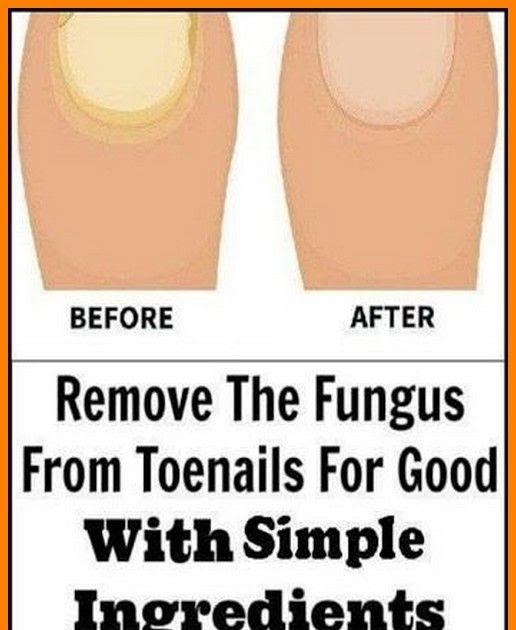 3 Simple and Effective Natural Cures for Toenail Fungus