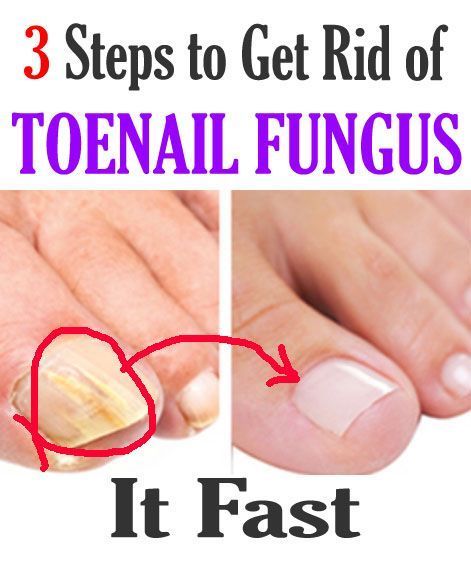 3 Steps To Get Rid Of ToeNail Fungus! #nailfungus #fungus #nail #health ...