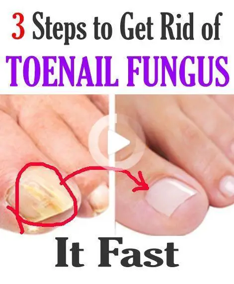 3 Steps To Get Rid Of ToeNail Fungus!