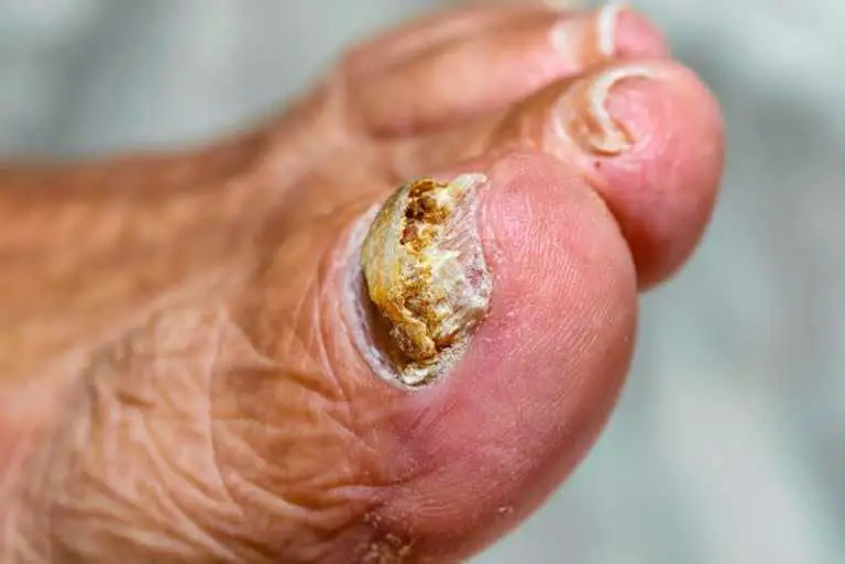 30 Natural Ways to Deal with Nail Fungus