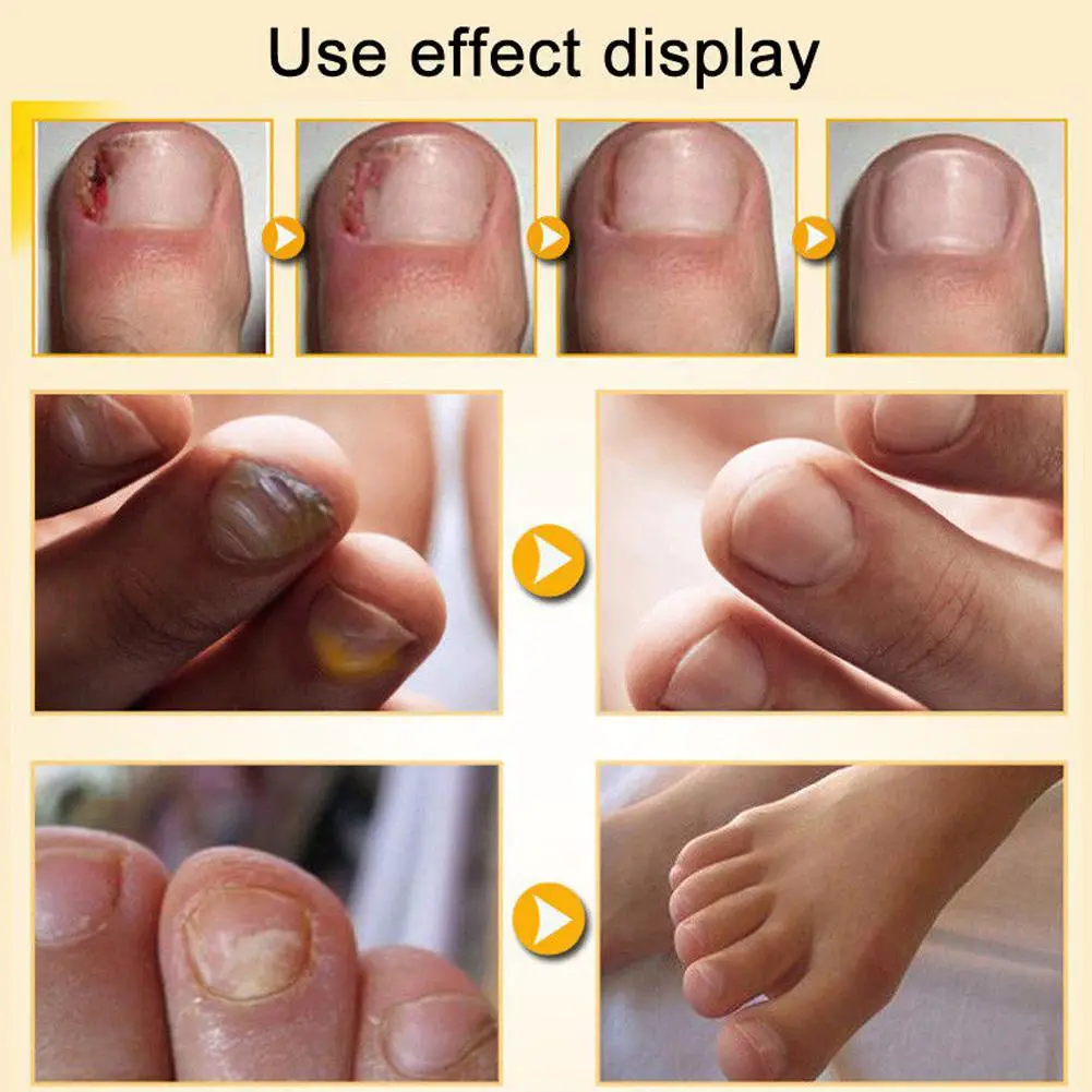 30ml Fungal Nail Treatment Essence Toe Foot Nail Finger Fungus new