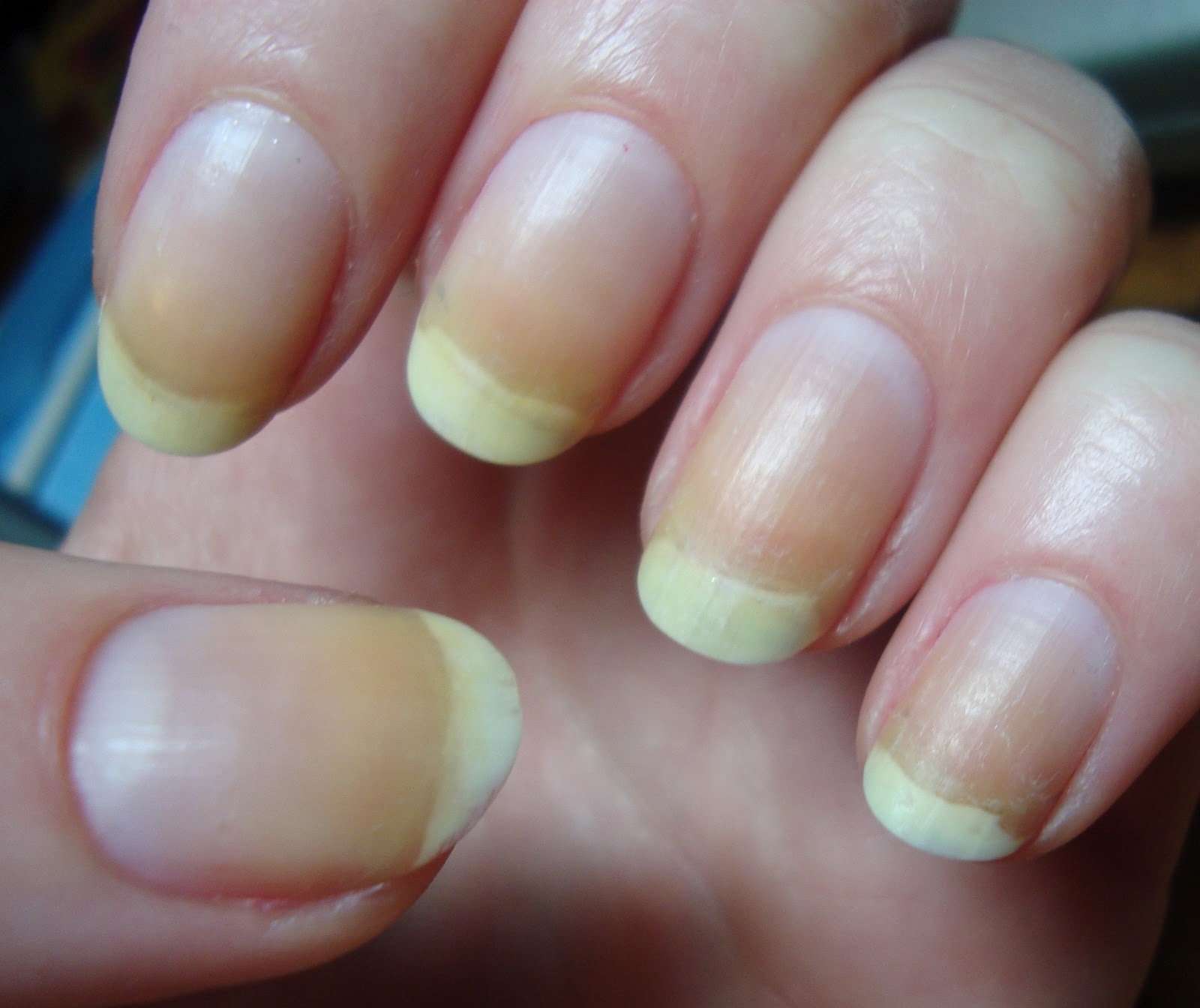5 Fast Ways To Treat Discolored Nails » News,Business ...