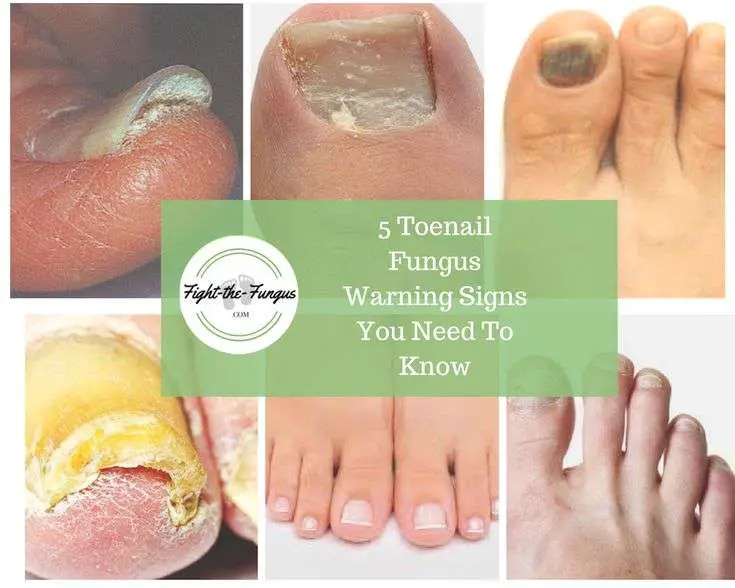5 Toenail Fungus Warning Signs You Need To Know, RIGHT NOW ...