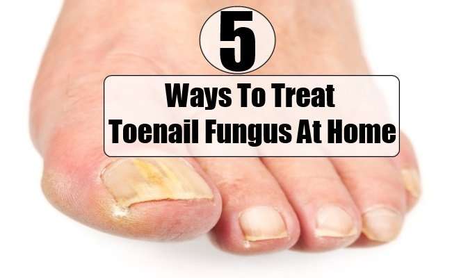 5 Ways To Treat Toenail Fungus At Home
