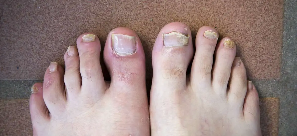 6 Myths You Need To Know About Fungal Nails