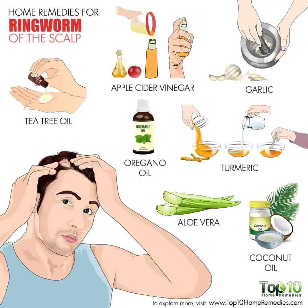 7 Home Remedies to Fight Ringworm of the Scalp