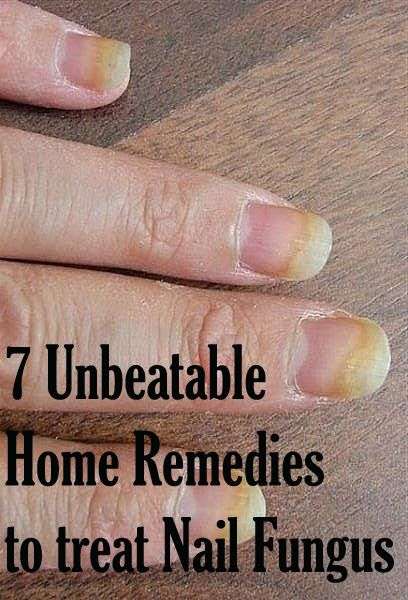 7 Unbeatable Home Remedies to treat Nail Fungus