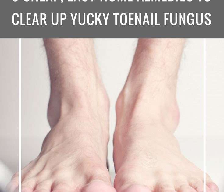 9 Cheap, Easy Home Remedies to Clear Up Yucky Toenail Fungus # ...