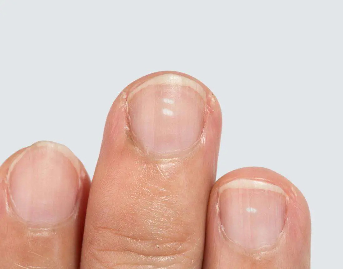 9 Health Warning Signs Revealed By Looking At Your Nails!