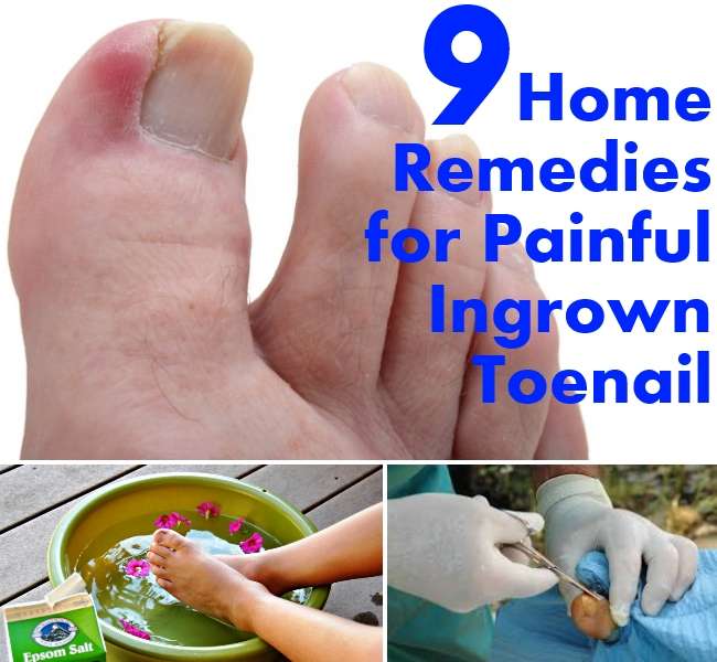 9 Home Remedies for Painful Ingrown Toenail