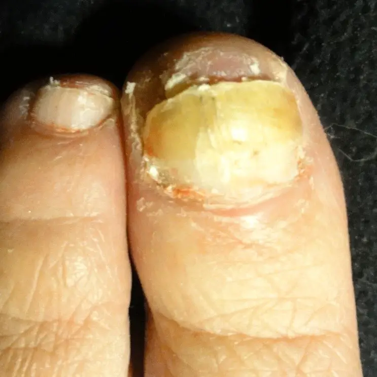 A Fingernail Fungus Solution that works!