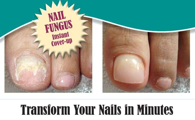 A thin layer of acrylic can build a new toenail