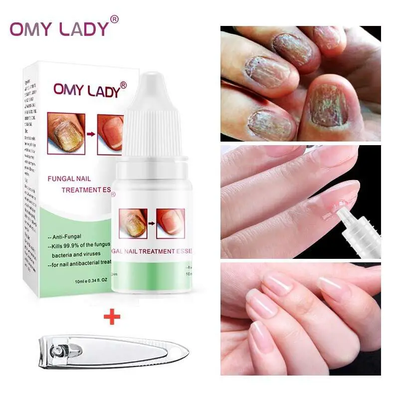 Aliexpress.com : Buy OMYLADY Fungal Nail Treatment Essence ...