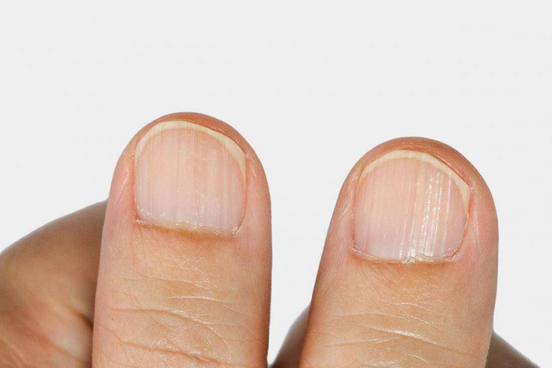 All you need to know about ridges in fingernails ...