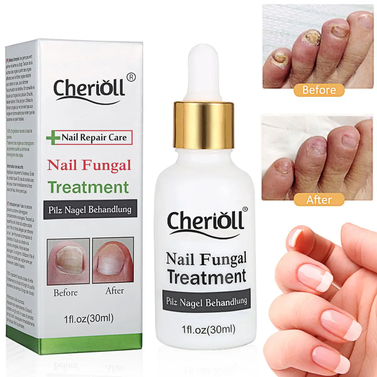 Amazon.com: Nail Antifungal Treatment,Nail Fungus Treatments,Anti ...