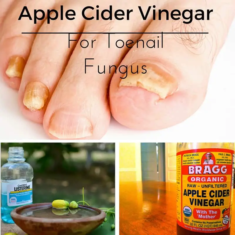 Apple Cider Vinegar For Toenail Fungus