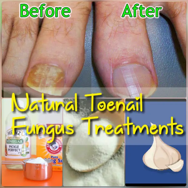 Are there any good home remedies for killing toenail fungus?