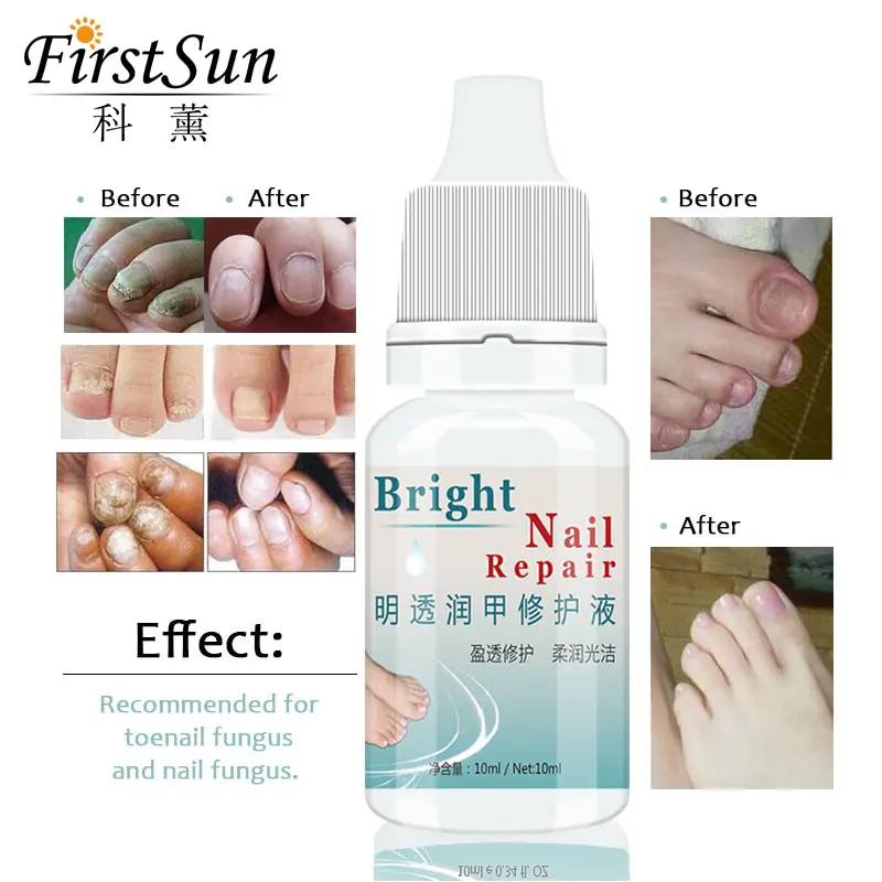 Best Fungal Onychomycosis Fungal Nail Treatment Toe Nail Serum Repair ...