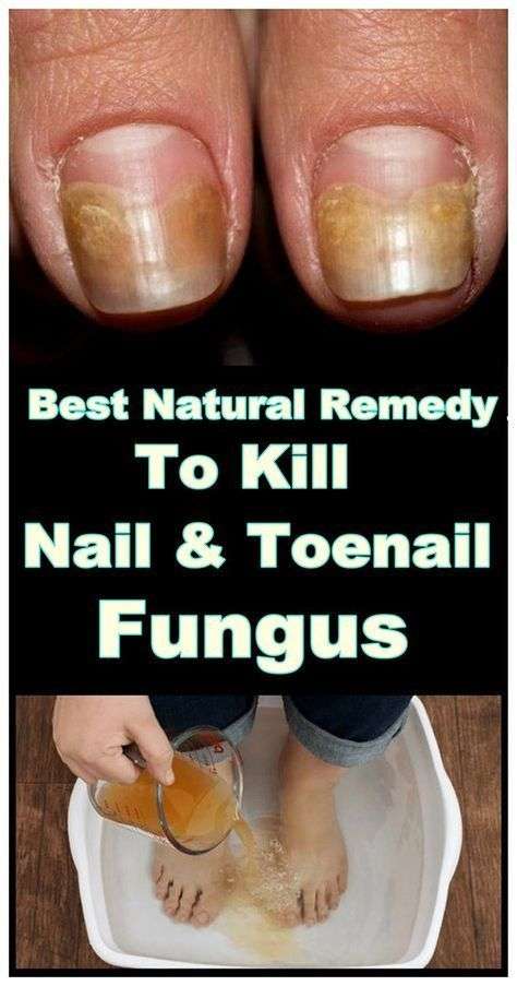 Best Natural Remedy To Kill Nail And Toenail Fungus# ...