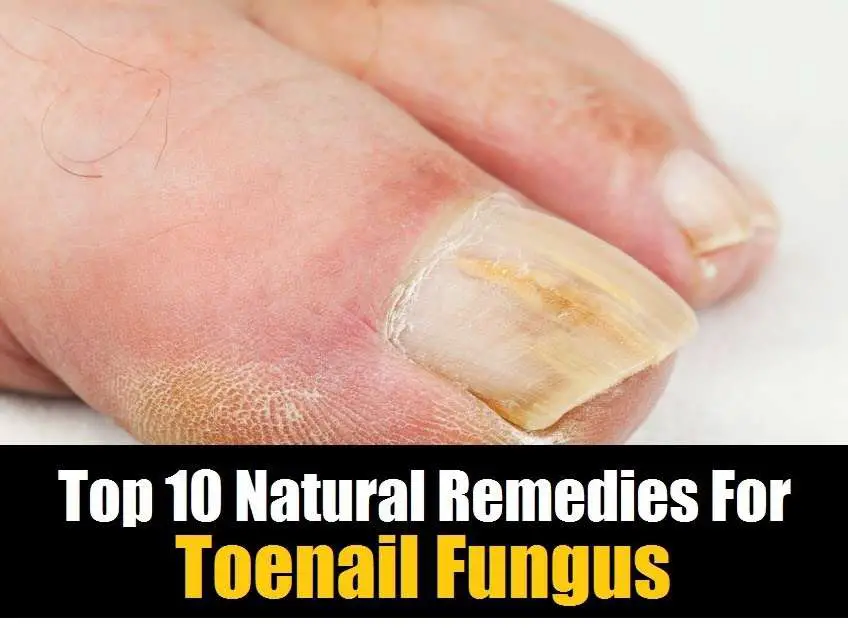 Best Toenail Fungus Treatment : Toenail Fungus Treatment, Nail Fungus ...