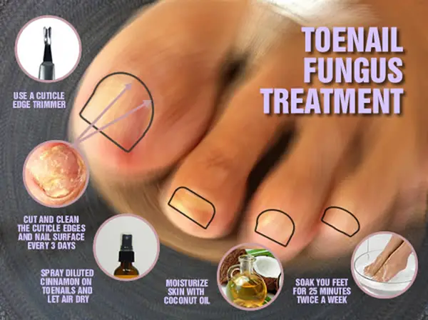 Best Toenail Fungus Treatment with Cinnamon Oil â Cinnamon ...