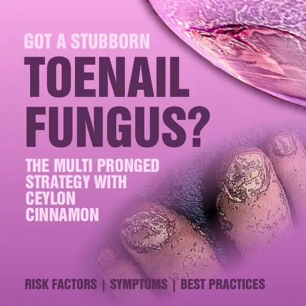 Best Toenail Fungus Treatment With Cinnamon Oil