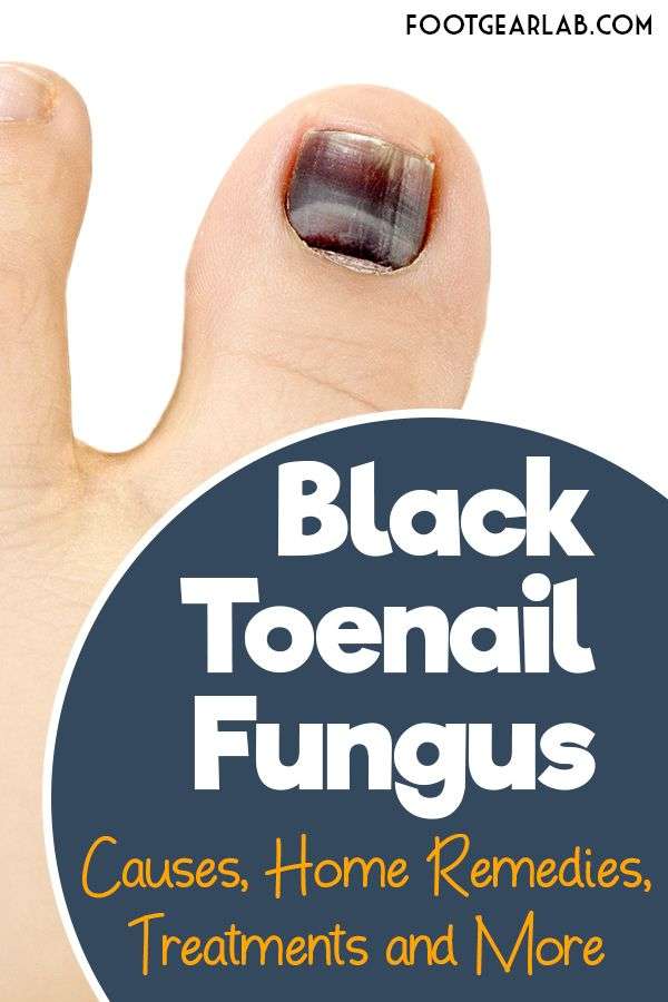 Black Toenail Fungus: Causes, Home Remedies, Treatments And More (With ...