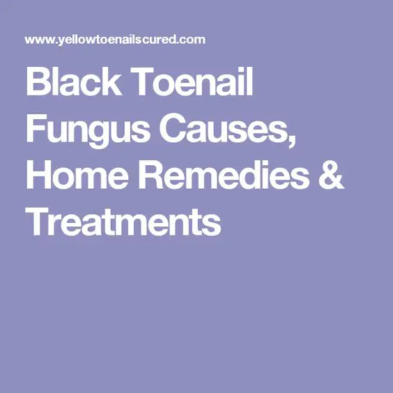 Black toenail fungus, Toenails and Home remedies on Pinterest