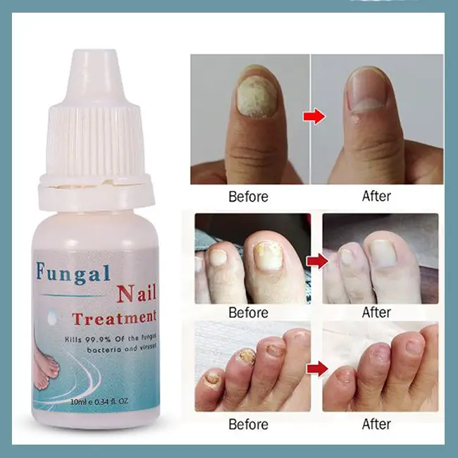 Bright Nail Repair Toenail Fungus Treatment, 10 mL