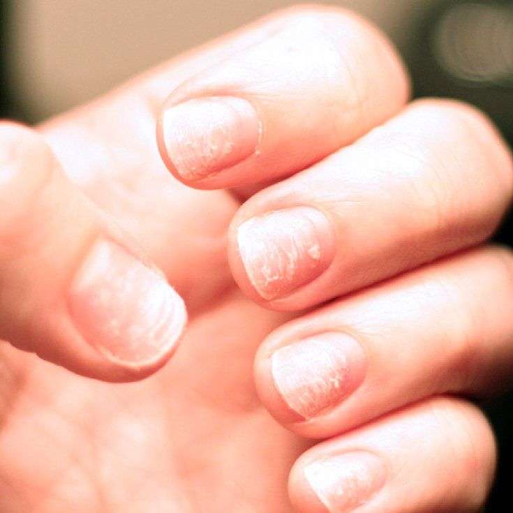 Brittle Nails: Causes &  Risk Factors + 9 Natural ...