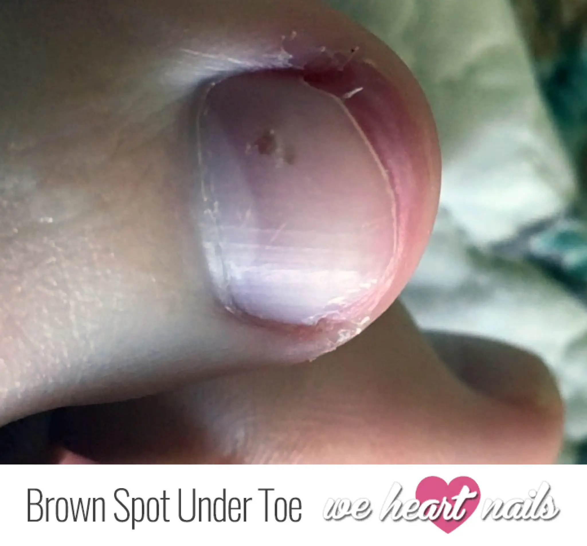 Brown Spots Under Toenail
