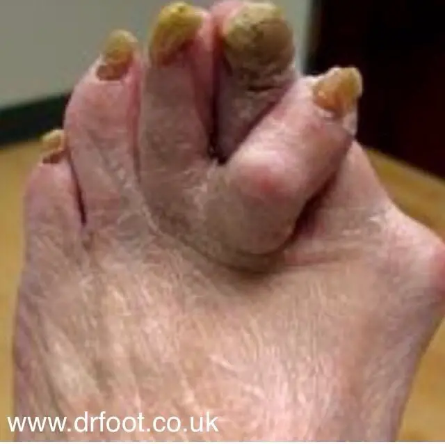 Bunion surgery expert, we treat them all from mild to severe