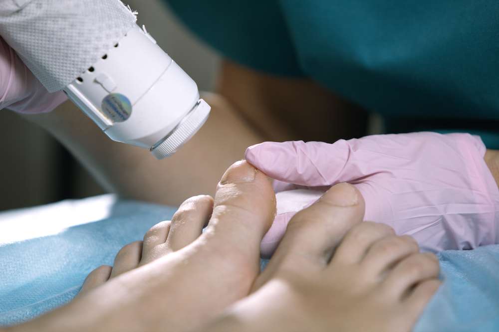 Can Laser Treatments Cure Toenail Fungus? What the Research Shows