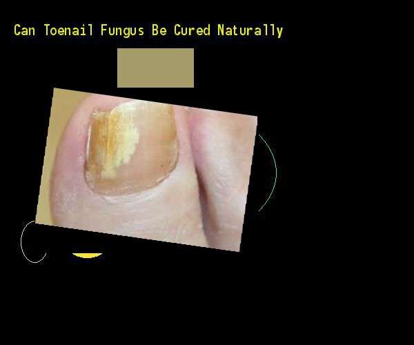Can toenail fungus be cured naturally