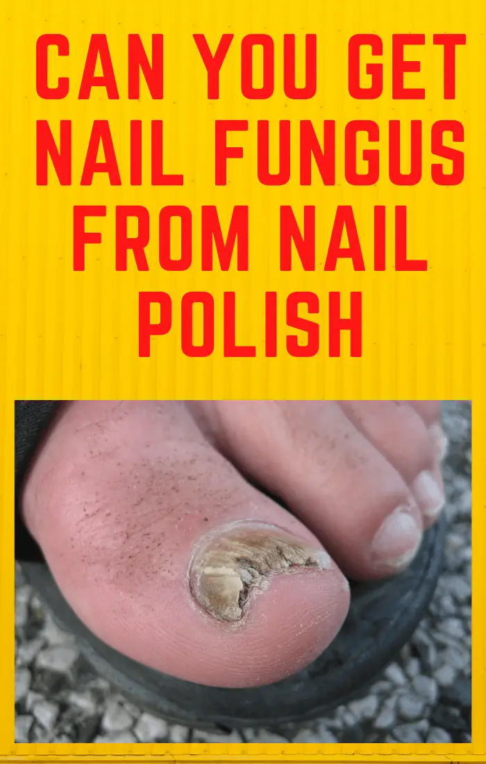Can You Get Nail Fungus From Nail Polish?