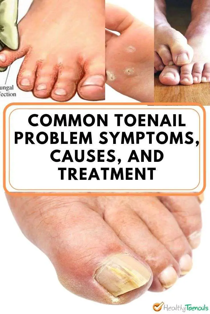 Common toenail problems and treatments #problems #toenail ...