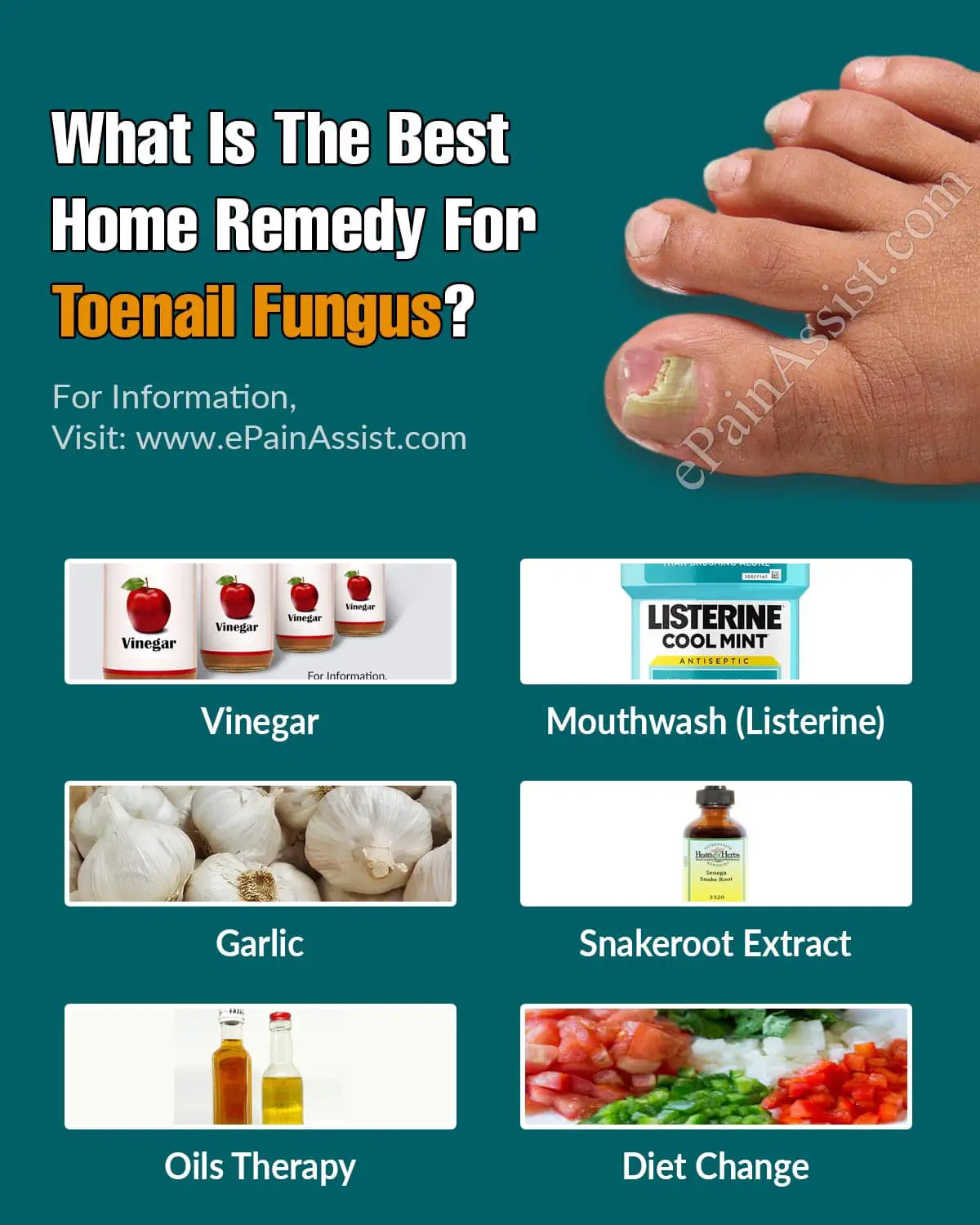 Cure Toenail Fungus Listerine