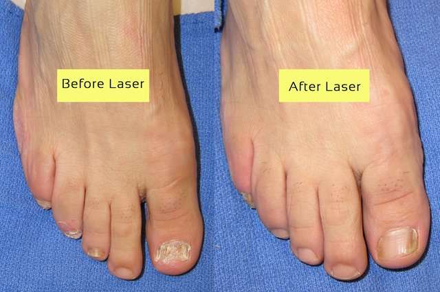 Cutera Laser for nail fungus before and after pictures