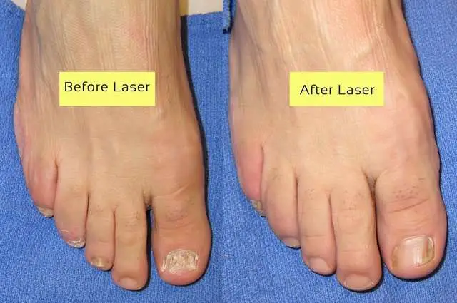 Cutera Laser for nail fungus before and after pictures ...