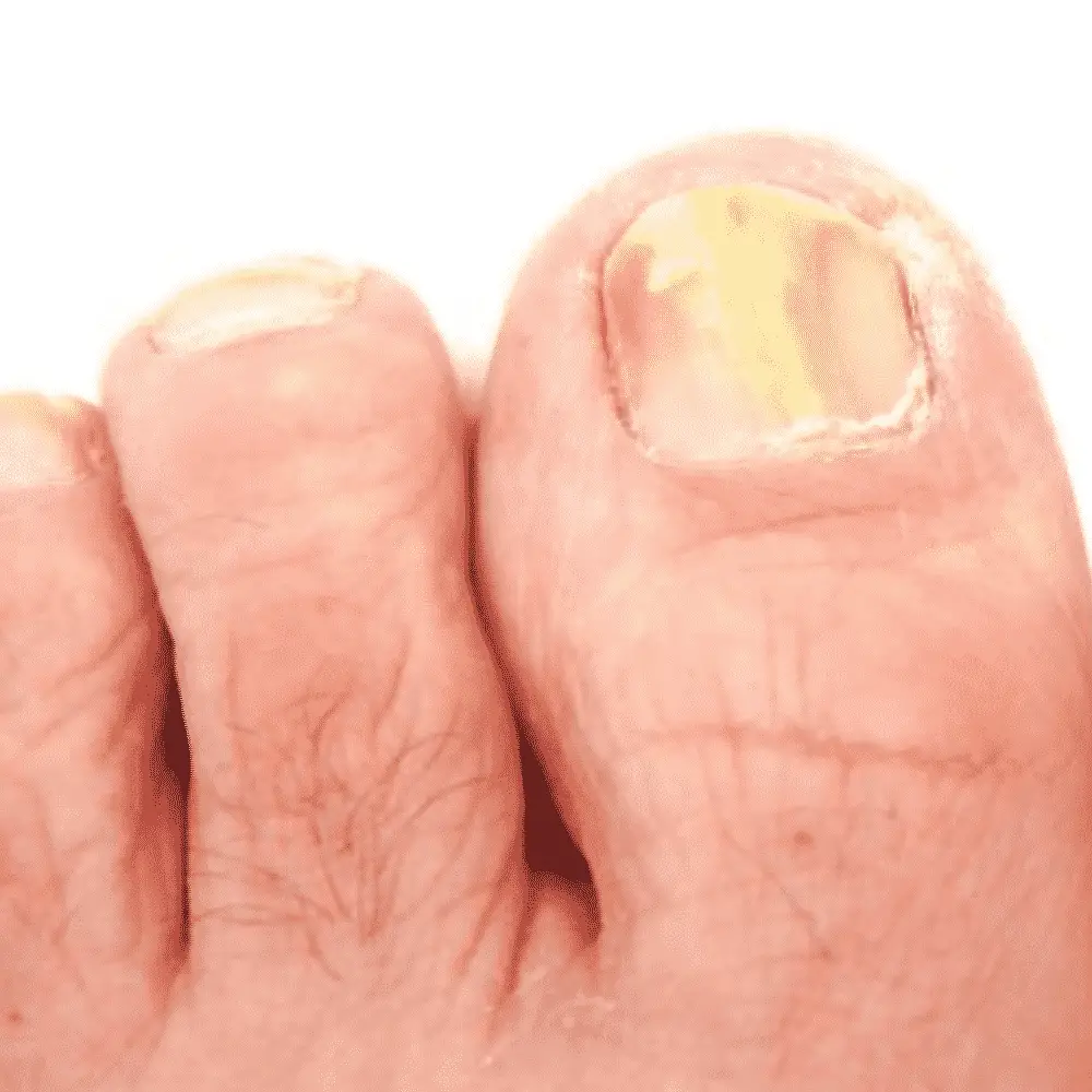 Dangers of Ignoring a Toenail Fungus Infection