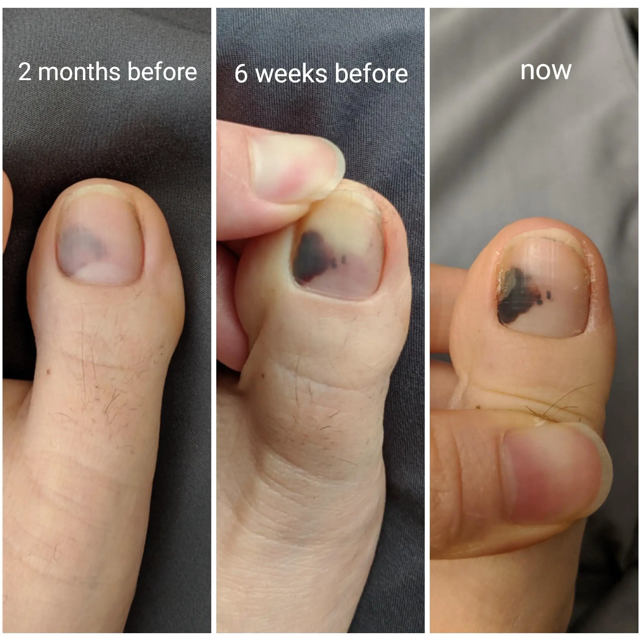 Dark spot under toenail, not growing/spreading but darkening. Fungal ...